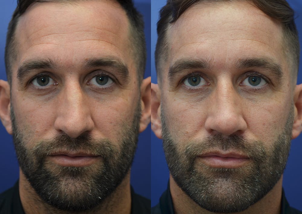 Rhinoplasty (Nose Reshaping) Before & After Gallery - Patient 5289018 - Image 3