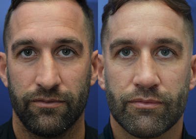 Rhinoplasty (Nose Reshaping) Before & After Gallery - Patient 5289018 - Image 1