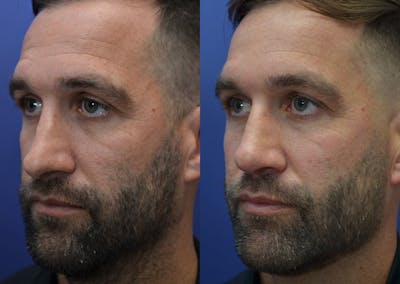Rhinoplasty (Nose Reshaping) Before & After Gallery - Patient 5289018 - Image 2