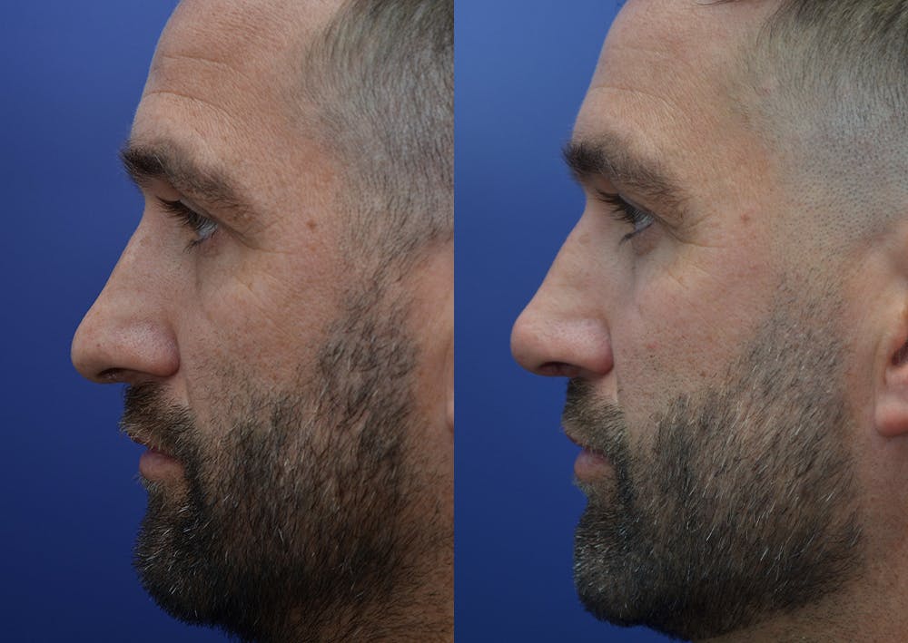 Rhinoplasty (Nose Reshaping) Before & After Gallery - Patient 5289018 - Image 3
