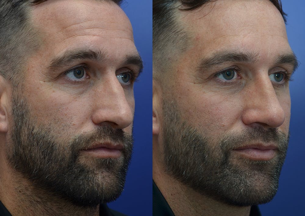 Rhinoplasty (Nose Reshaping) Before & After Gallery - Patient 5289018 - Image 1