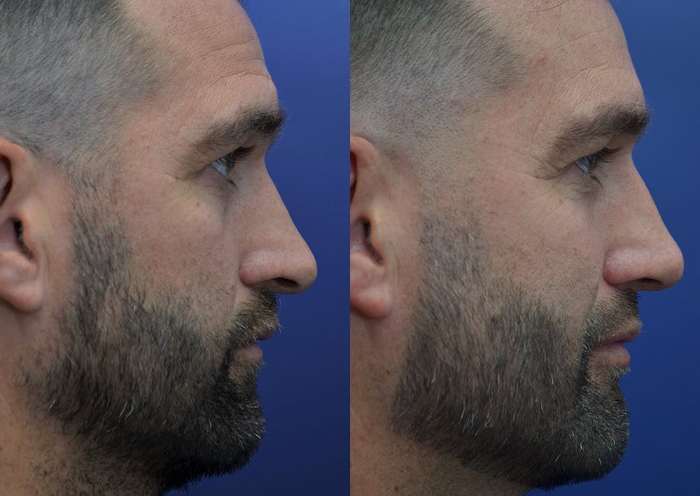 Rhinoplasty (Nose Reshaping) Before & After Gallery - Patient 5289018 - Image 5