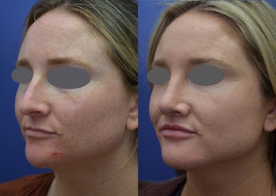 Rhinoplasty (Nose Reshaping) Before & After Gallery - Patient 14391501 - Image 2