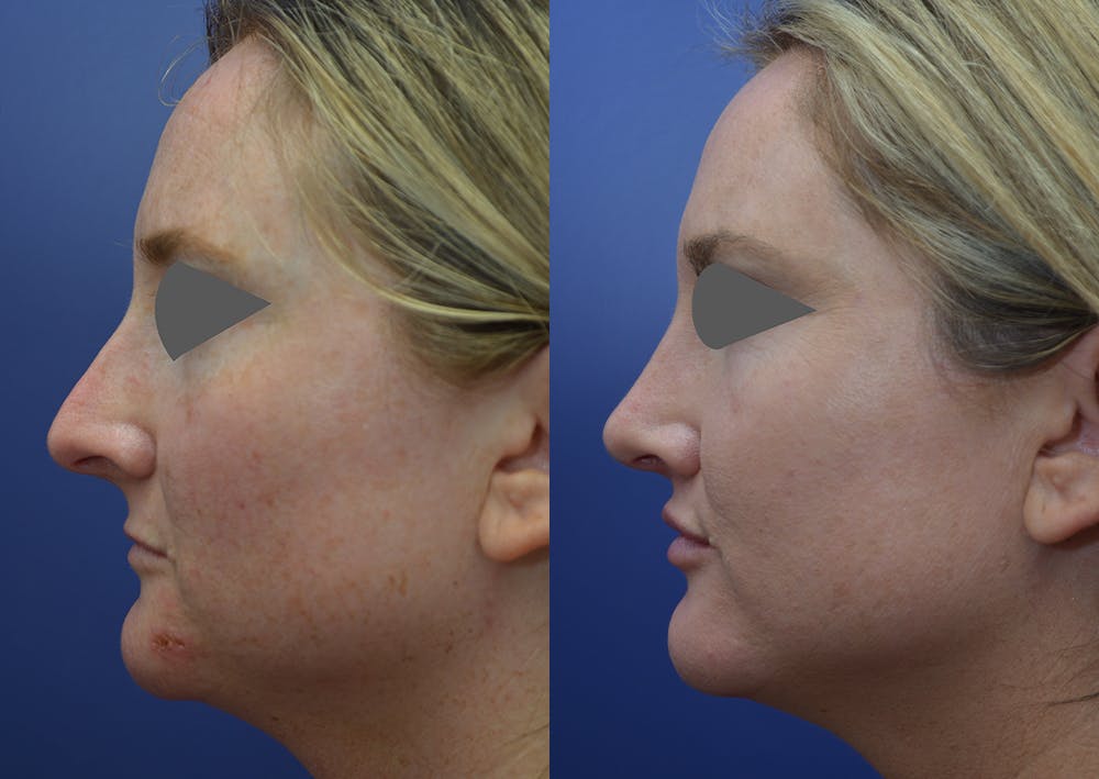Rhinoplasty (Nose Reshaping) Before & After Gallery - Patient 14391501 - Image 3