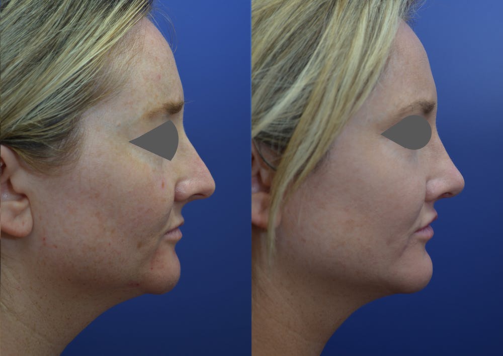 Rhinoplasty (Nose Reshaping) Before & After Gallery - Patient 14391501 - Image 5