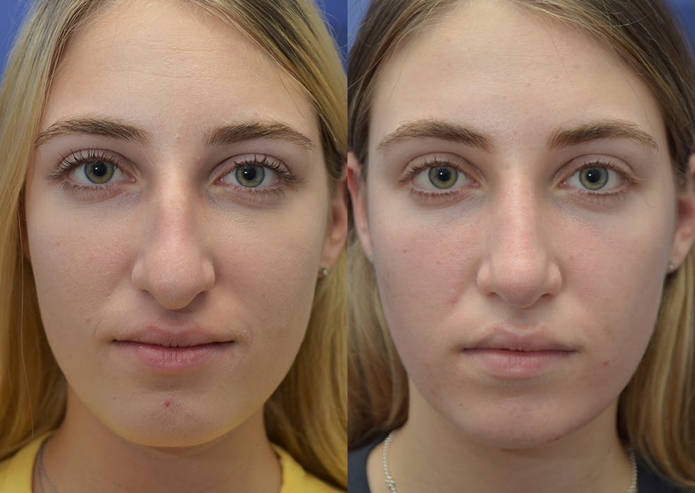 Rhinoplasty (Nose Reshaping) Before & After Gallery - Patient 5930630 - Image 1