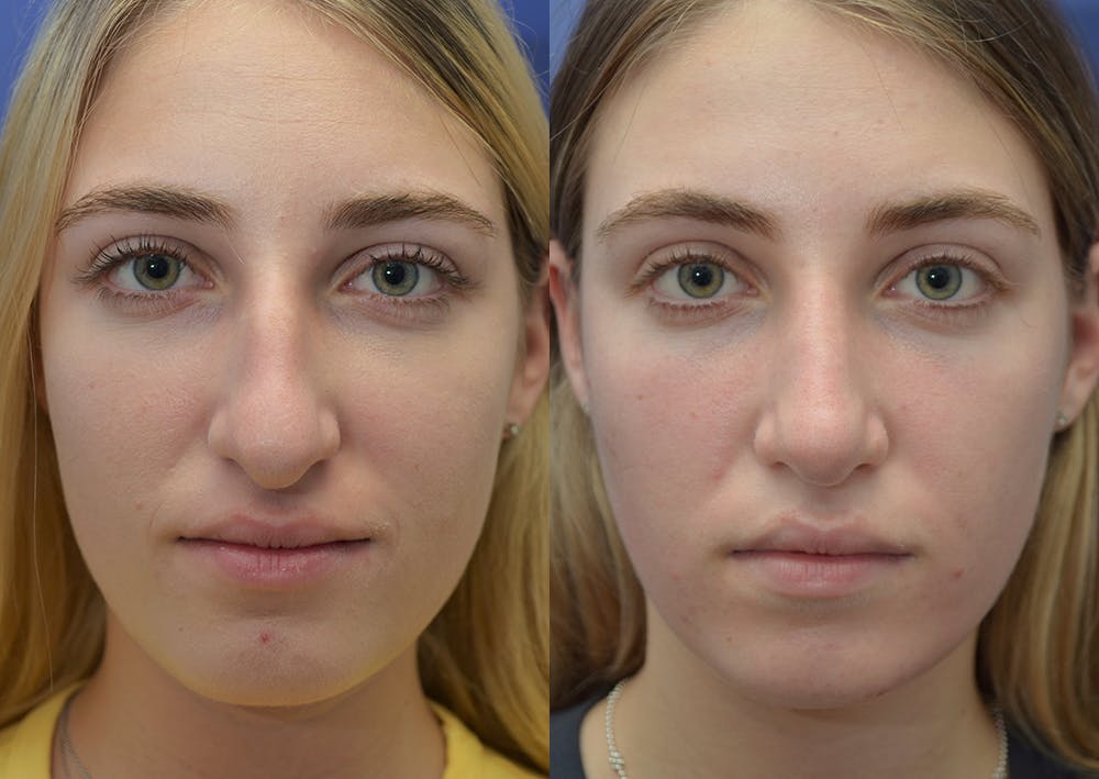 Rhinoplasty (Nose Reshaping) Gallery - Patient 5930630 - Image 1