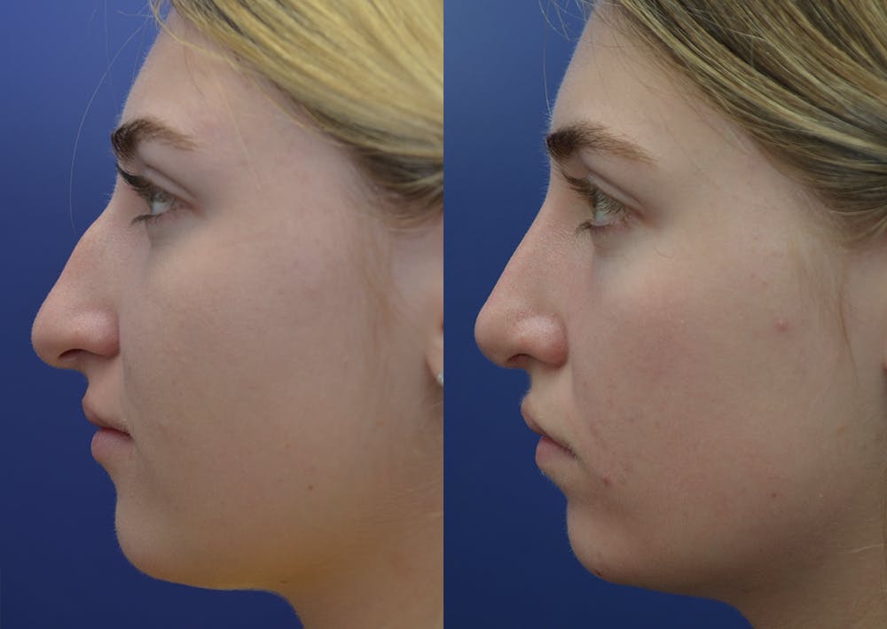 Rhinoplasty (Nose Reshaping) Before & After Gallery - Patient 5930630 - Image 3