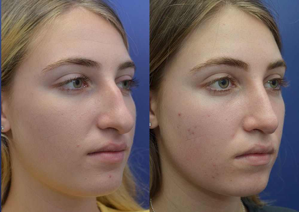 Rhinoplasty (Nose Reshaping) Before & After Gallery - Patient 5930630 - Image 4