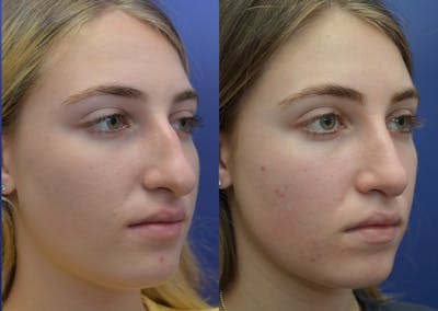 Rhinoplasty (Nose Reshaping) Before & After Gallery - Patient 5930630 - Image 4