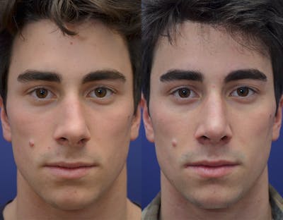 Rhinoplasty (Nose Reshaping) Before & After Gallery - Patient 19339316 - Image 1