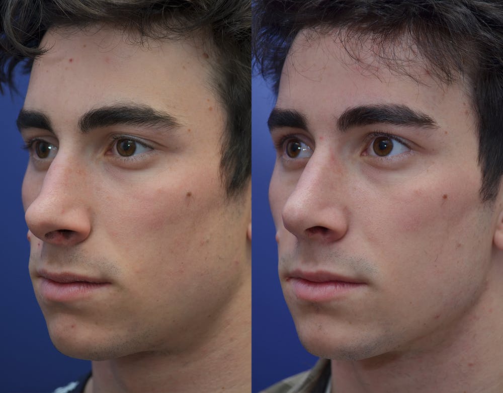 Rhinoplasty (Nose Reshaping) Before & After Gallery - Patient 19339316 - Image 2