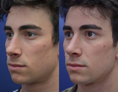 Rhinoplasty (Nose Reshaping) Before & After Gallery - Patient 19339316 - Image 2