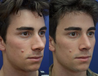 Rhinoplasty (Nose Reshaping) Before & After Gallery - Patient 19339316 - Image 4