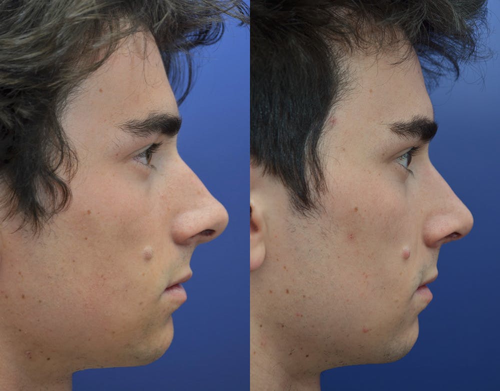 Rhinoplasty (Nose Reshaping) Before & After Gallery - Patient 19339316 - Image 5