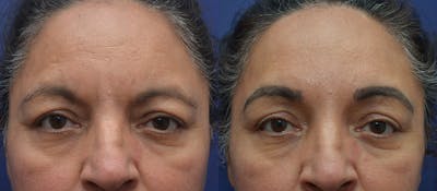 Brow Lift (Forehead Lift) Before & After Gallery - Patient 5788717 - Image 1
