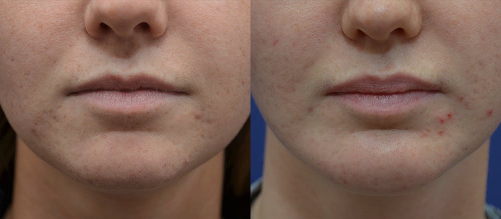 Lip Augmentation Before & After Gallery - Patient 19339345 - Image 1
