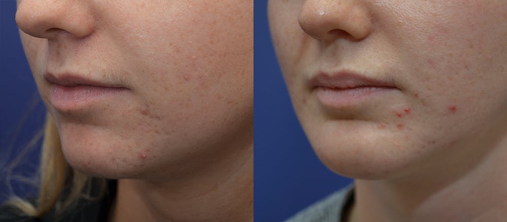Chin Augmentation Before & After Gallery - Patient 19339355 - Image 2