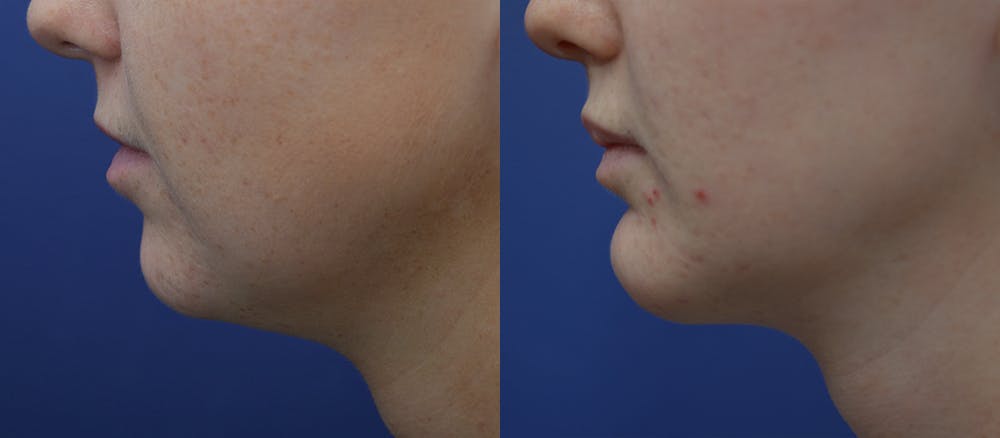 Lip Augmentation Before & After Gallery - Patient 19339345 - Image 3