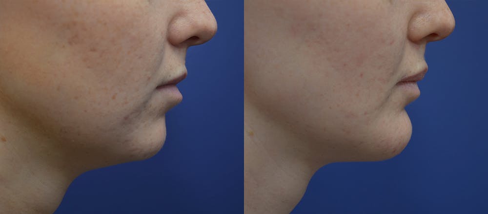 Lip Augmentation Before & After Gallery - Patient 19339345 - Image 5