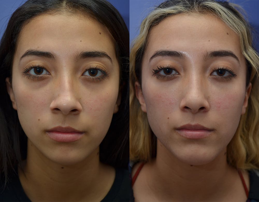 Under Eye Rejuvenation Before & After Gallery - Patient 19339364 - Image 1