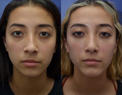 Under Eye Rejuvenation Before & After Gallery - Patient 19339364 - Image 1