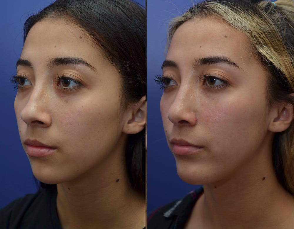 Under Eye Rejuvenation Before & After Gallery - Patient 19339364 - Image 2