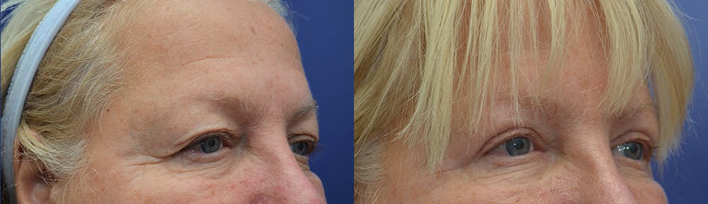 Eyelid Surgery Before & After Gallery - Patient 19339373 - Image 3