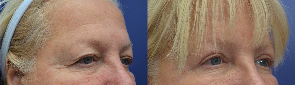 Eyelid Surgery Before & After Gallery - Patient 19339373 - Image 3