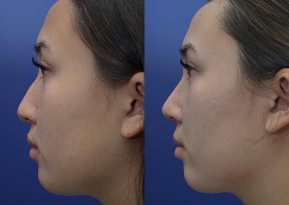 Rhinoplasty (Nose Reshaping) Before & After Gallery - Patient 22114417 - Image 3
