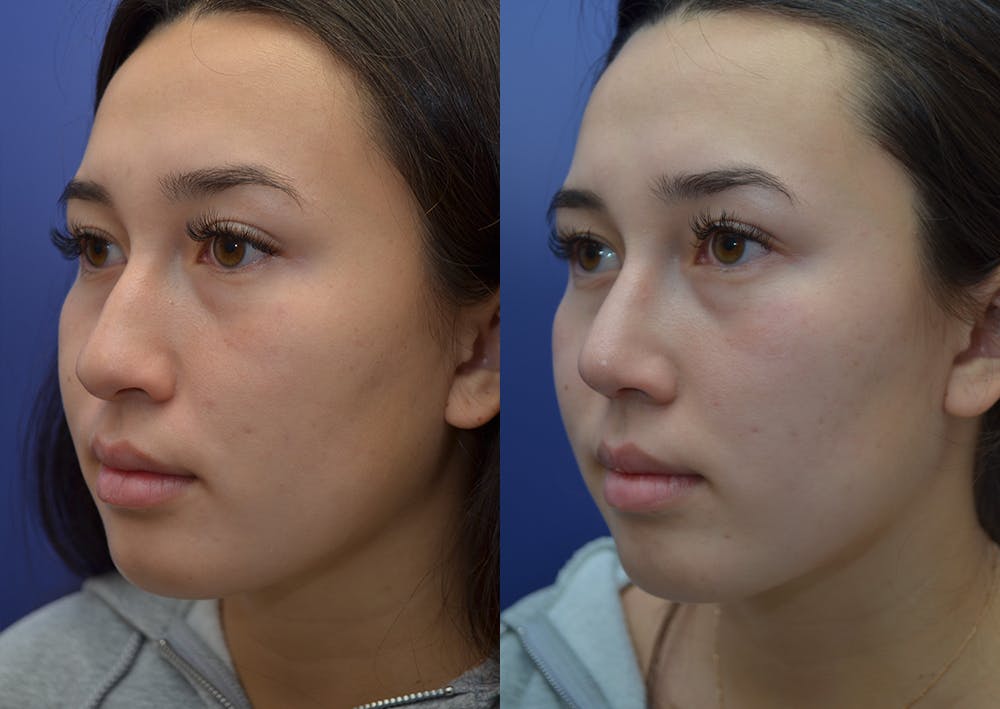 Rhinoplasty (Nose Reshaping) Before & After Gallery - Patient 22114417 - Image 2