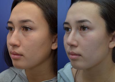 Rhinoplasty (Nose Reshaping) Before & After Gallery - Patient 22114417 - Image 2
