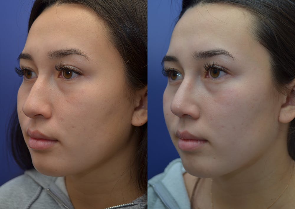 Rhinoplasty (Nose Reshaping) Gallery - Patient 22114417 - Image 2