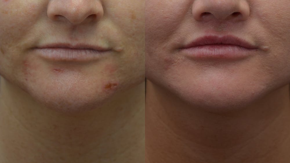 Lip Enhancement Before & After Gallery - Patient 14391507 - Image 1