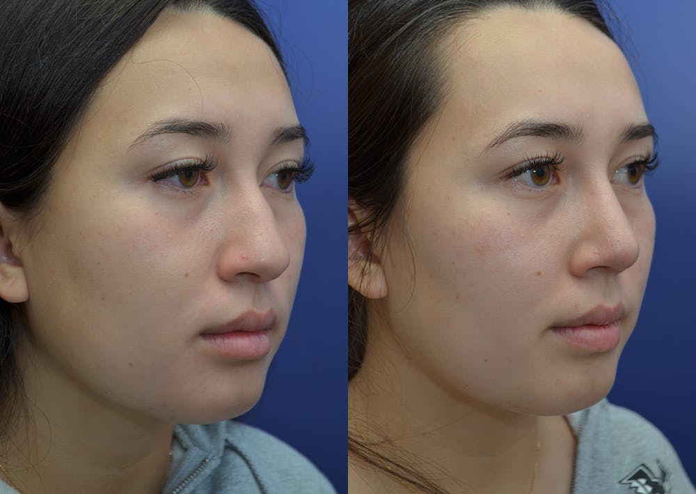 Rhinoplasty (Nose Reshaping) Before & After Gallery - Patient 22114417 - Image 4