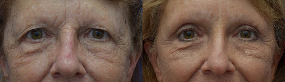 Eyelid Surgery Before & After Gallery - Patient 25623413 - Image 1