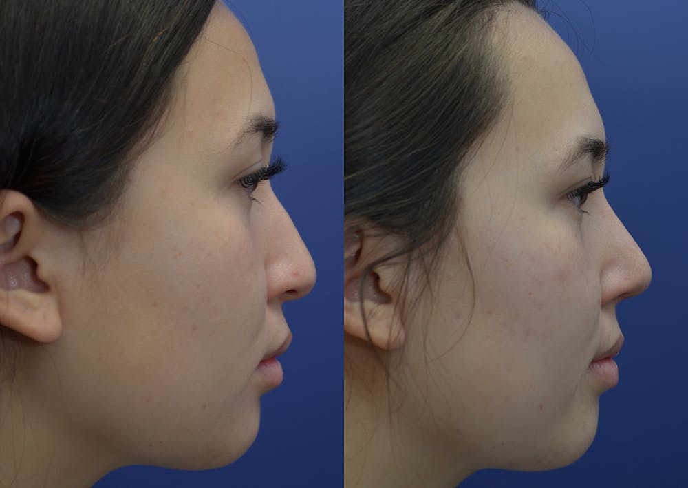 Rhinoplasty (Nose Reshaping) Before & After Gallery - Patient 22114417 - Image 5