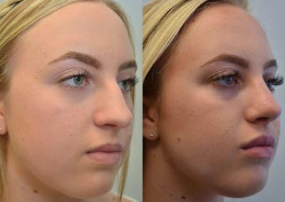 Rhinoplasty (Nose Reshaping) Before & After Gallery - Patient 4588550 - Image 2