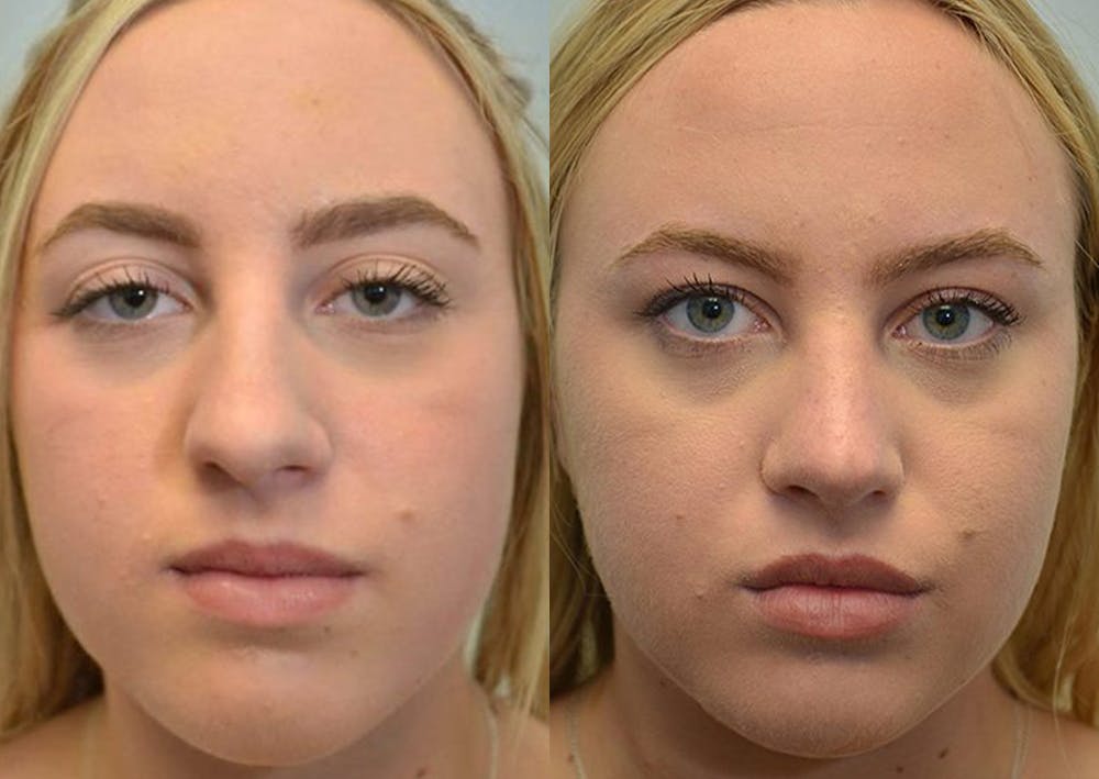 Rhinoplasty (Nose Reshaping) Before & After Gallery - Patient 4588550 - Image 1