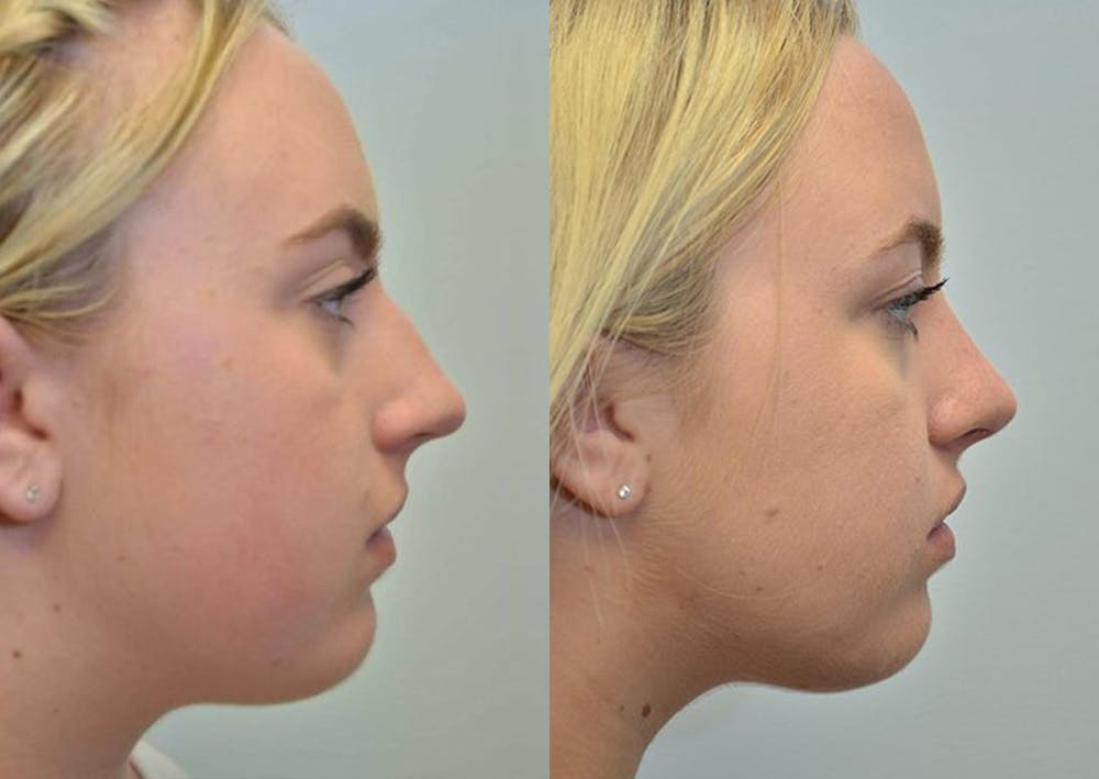 Rhinoplasty (Nose Reshaping) Before & After Gallery - Patient 4588550 - Image 3