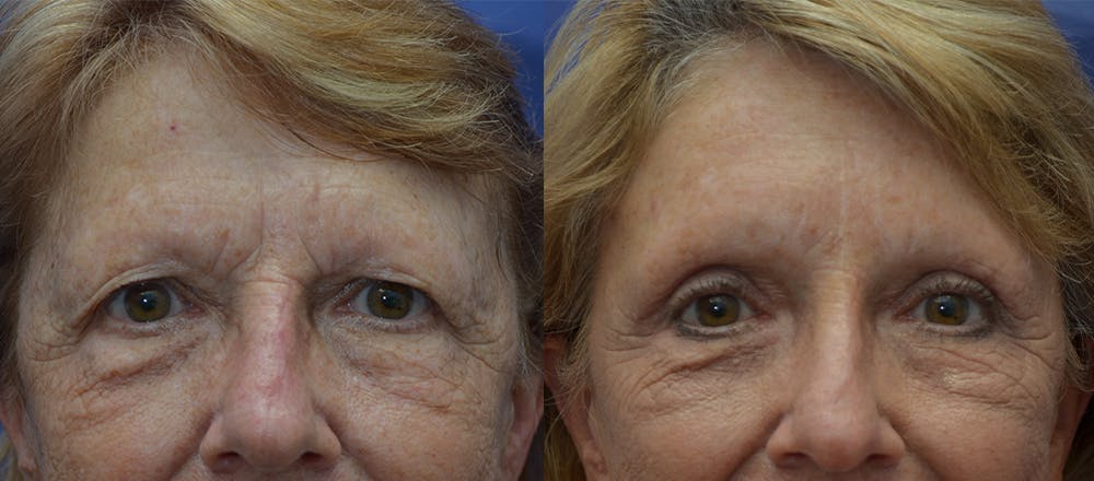 Brow Lift (Forehead Lift) Before & After Gallery - Patient 25623435 - Image 1