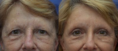 Brow Lift (Forehead Lift) Before & After Gallery - Patient 25623435 - Image 1