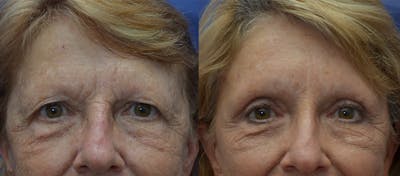 Brow Lift (Forehead Lift) Gallery - Patient 25623435 - Image 1