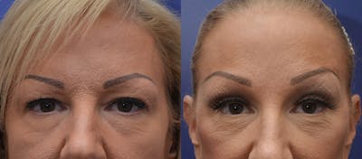 Brow Lift (Forehead Lift) Before & After Gallery - Patient 4588634 - Image 1