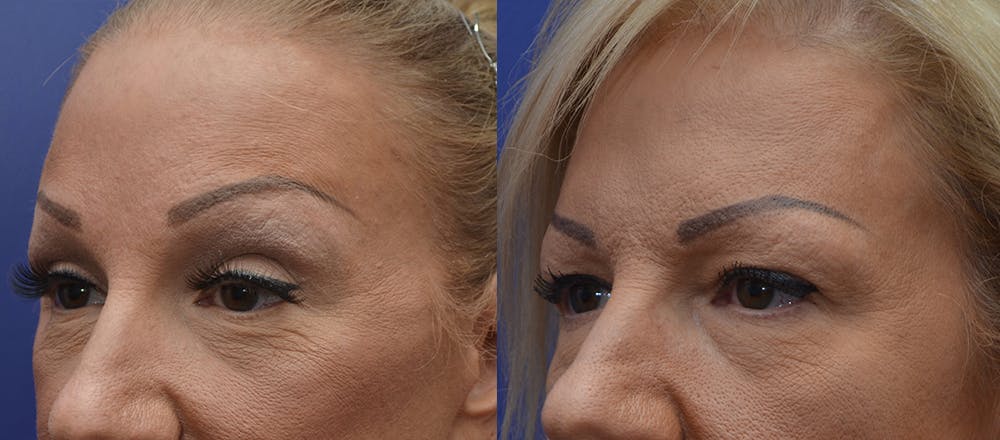 Brow Lift (Forehead Lift) Before & After Gallery - Patient 4588634 - Image 2