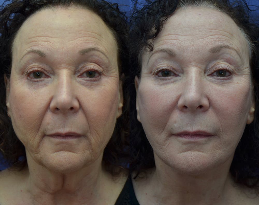 Deep Plane Facelift Before & After Gallery - Patient 30352962 - Image 1
