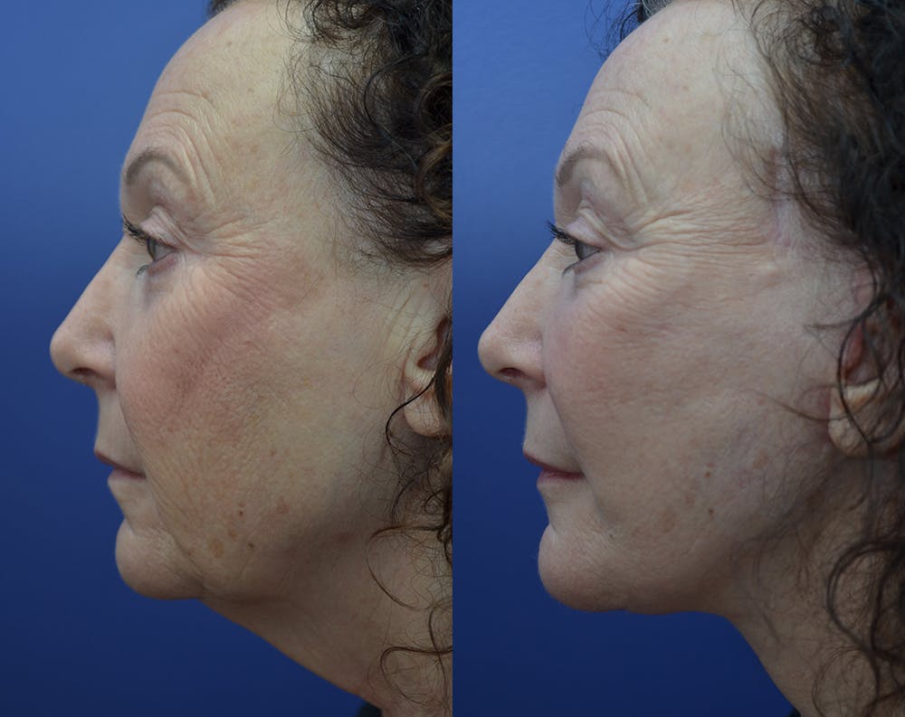 Deep Plane Facelift Before & After Gallery - Patient 30352962 - Image 3