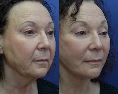 Deep Plane Facelift Before & After Gallery - Patient 30352962 - Image 4