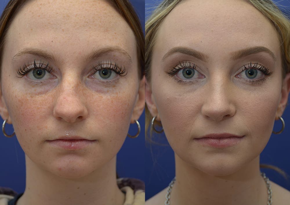 Rhinoplasty (Nose Reshaping) Before & After Gallery - Patient 30353997 - Image 1