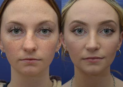 Rhinoplasty (Nose Reshaping) Before & After Gallery - Patient 30353997 - Image 1